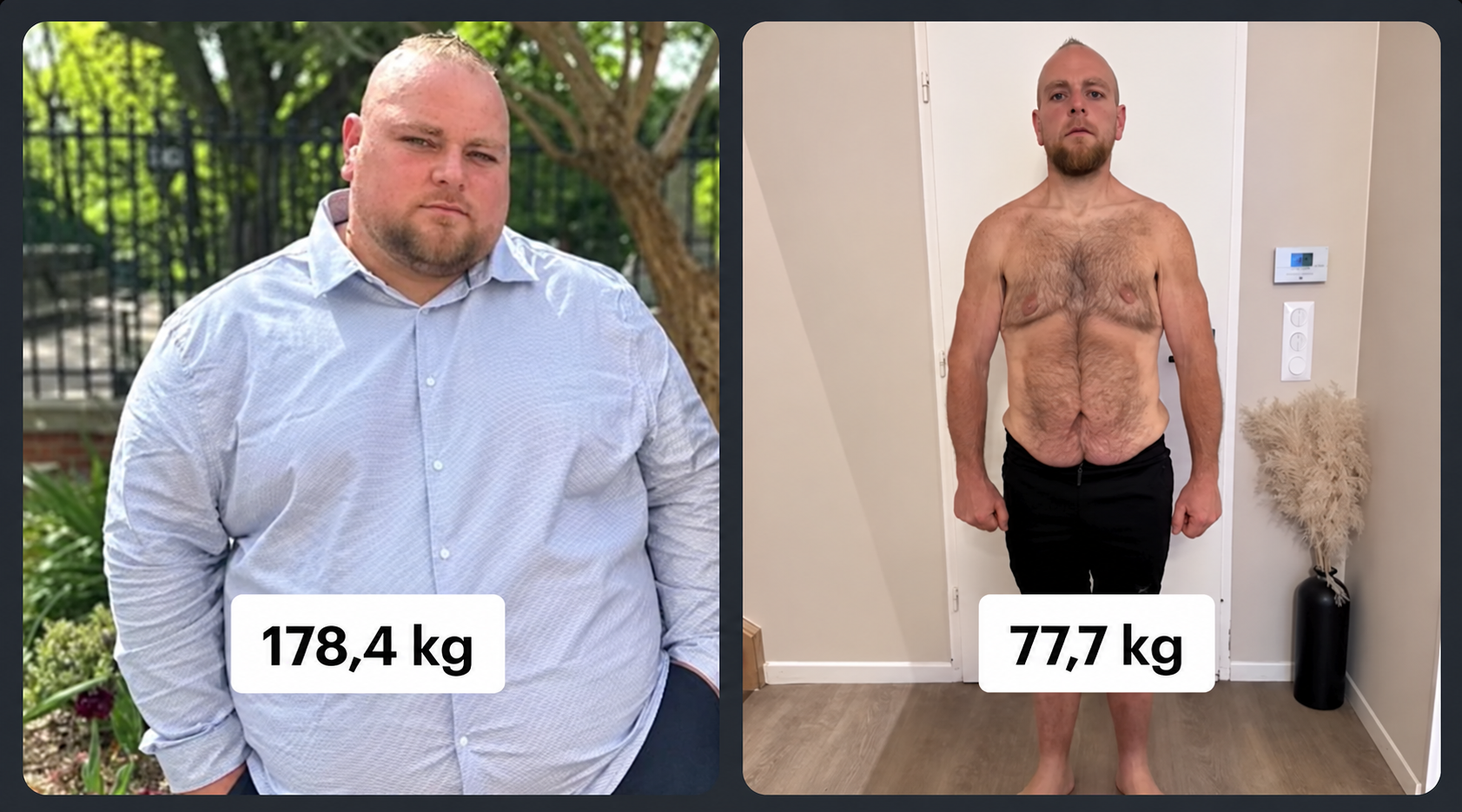 Comparatif avant / après : Bruno Mougenot à 178,4 kg en chemise bleue, puis à 77,7 kg un an plus tard